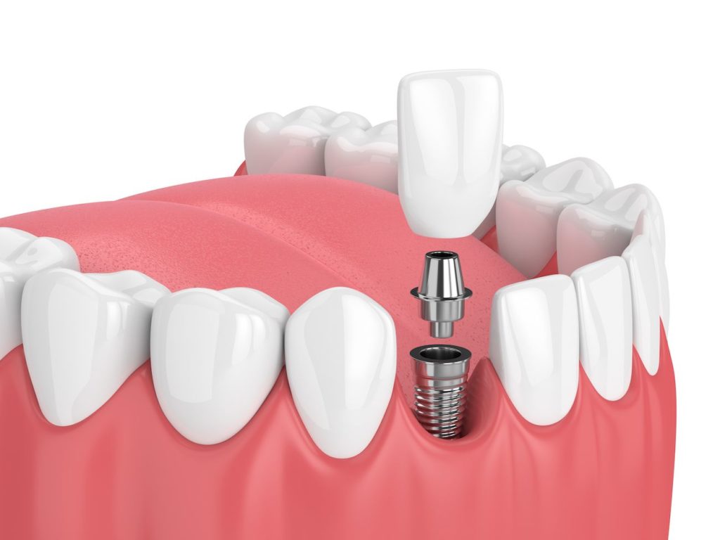 dental implant patient Doylestown Pennsylvania