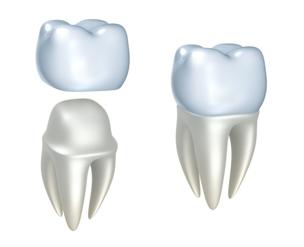 ceramic cap placement for dental crowns