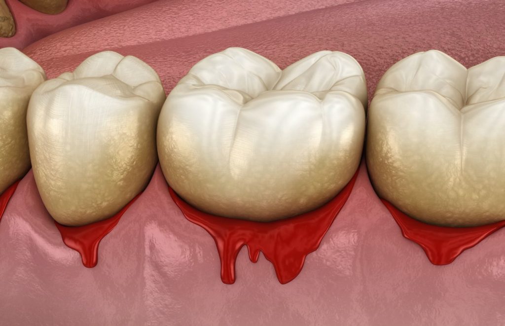 advanced gum disease treatment