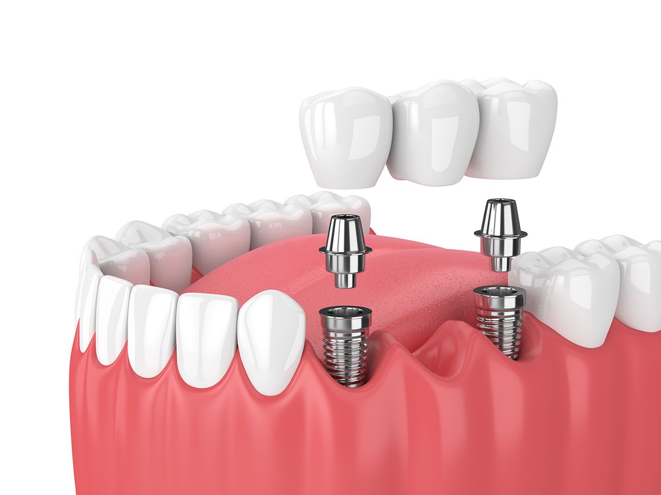 types of dental implants