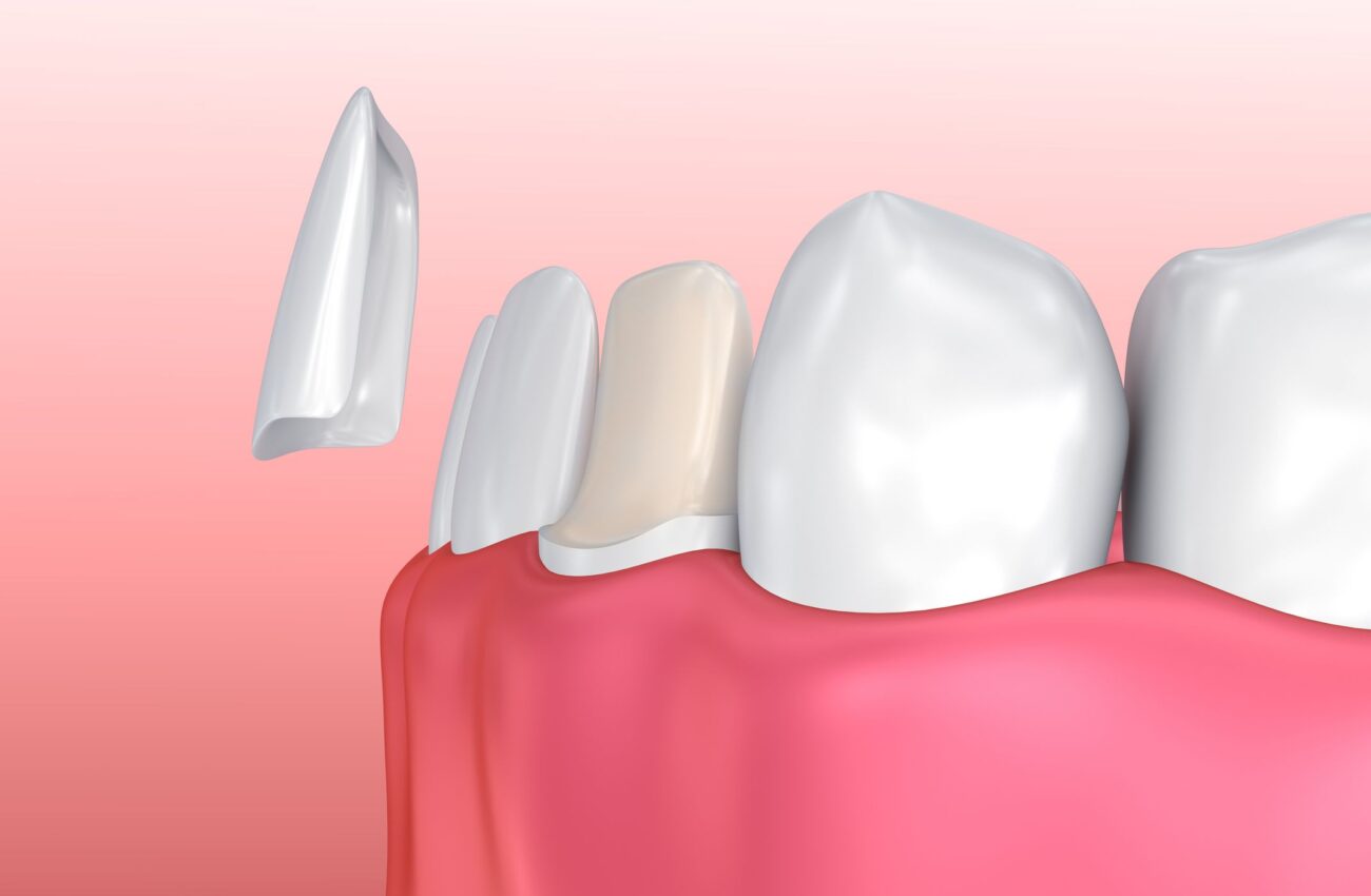 Changing Your Smile with Veneers